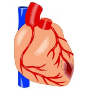 simptome cardiace minore și semne de tratament
