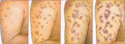 Natural sau variola că o astfel și așa cum se arată (tratate numai prin intermediul) Natural sau variola, care este și modul în care să se manifeste