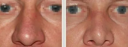 cartofi nas, nas rinoplastie cartof (rinoplastie) nas bulbos, cartofi nas rinoplastie