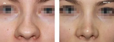 cartofi nas, nas rinoplastie cartof (vârf) nas bulbos, cartofi nas rinoplastie
