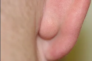 Bead formate pe cauza earlobe și tratament (format) Șirag de mărgele formate pe cauzele lobul urechii si tratament