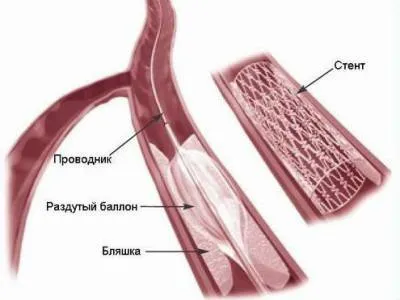 Ocluzia arterelor membrelor inferioare (femurală, poplitee) si tratamentul acesteia (de jos) Ocluzia arterelor membrelor inferioare (femurală, poplitee) și tratamentul acesteia