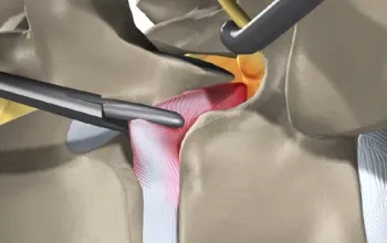 Chirurgie pentru a elimina o hernie spinale indicatii, riscuri si consecinte, costuri, reabilitare (intervenție chirurgicală pentru a elimina o hernie de indicii spinarii a costurilor de reabilitare consecințe periculoase) Chirurgie pentru a elimina o hernie spinale indicatii, riscuri și consecințe, costuri, reabilitare