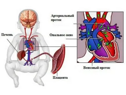 brevet foramen la nou-născuți și ovale sugari