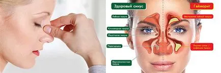 Pansinusitis ce este, simptome, tratament și tipuri de (tratament) Pansinusitis ce este, simptome, tratament si tipuri