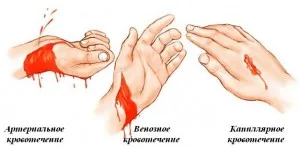 Primul ajutor pentru sângerare arterială pe articole