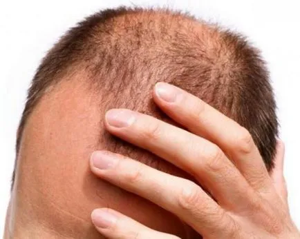 petic de chelie pe cap cauzele și tratament (aspect) petic de chelie pe cap cauzele și tratamentul său