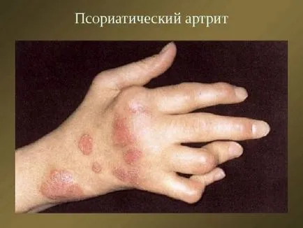 Artrita tratament articulatiilor degetelor, cauze si simptome (artrita) Artrita tratament articulațiilor degetelor, cauze și simptome