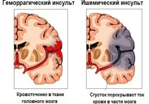 Consecințele accident vascular cerebral la persoanele vârstnice care estimările pentru cei peste 80 de ani