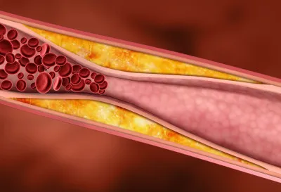 Consecințele accident vascular cerebral la persoanele vârstnice și prevenirea recurențelor la persoanele în vârstă, după 80 de ani