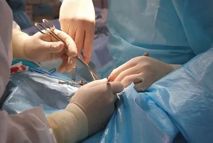 Lombara sympathectomy - curs chirurgie, nuanțe (lombare) Lombara sympathectomy - curs chirurgie, nuanțe