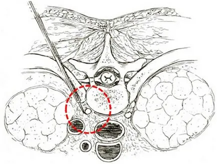Lombara sympathectomy - curs chirurgie, nuanțe (nuanțe) Lombara sympathectomy - curs chirurgie, nuanțe