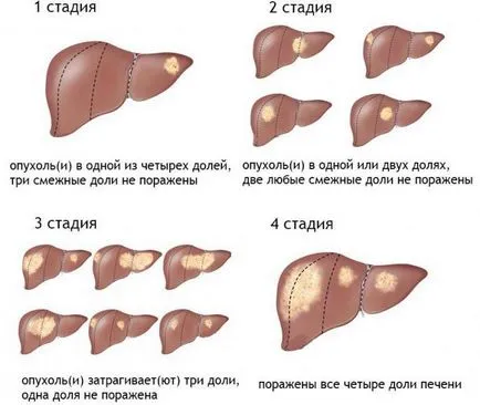Ultima etapă a simptomelor și o descriere a (cancer) de cancer Ultima etapă a simptomelor cancerului și descrierea