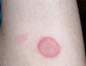 Apariția unor pete roșii pe piele cauzele si tratamentul alergiilor, pete pruriginoase de ce, foto (aspect) Apariția unor pete roșii pe piele cauzele și tratamentul alergiilor, pete pruriginoase de ce, fotografii