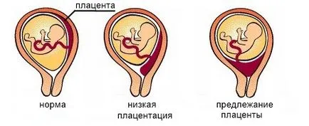 Placenta previa cauze, simptome, complicatii