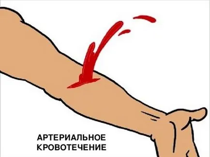 Utilizarea adecvată a unui garou cu sângerare arterială