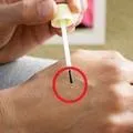 verucilor cauterizare cu azot lichid