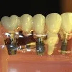 Semne si simptome de respingere dintre motivele principale implant dentar
