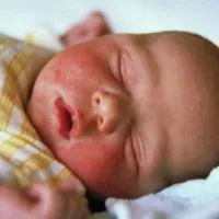 Altoirea Hib și de la care poate fi unele efecte secundare (vaccinul Hib pe ce) Altoirea Hib și de la care poate fi orice efecte secundare