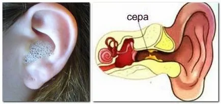 Ear lavaj tratament perhidrol otitei, îndepărtarea cerumen (ureche peroxid de hidrogen de curățare) Ear lavaj tratament perhidrol otitei, îndepărtarea cerumenului