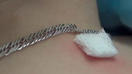 verucilor cauterizare cu azot lichid