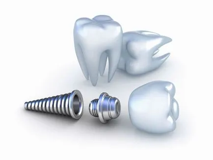 Semne si simptome de respingere dintre motivele principale implant dentar