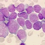 metastaza cancerului, onkostatus