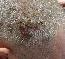 Pemfigus - cauze, simptome, diagnostic și tratament