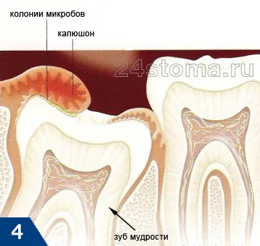 Cultivarea înțelepciunea dinte - ce să facă, ajutor rapid (în creștere) Cultivarea înțelepciunea dinte - ce să facă, ajutor rapid