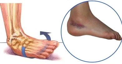 Entorse - cauze, simptome și tratament