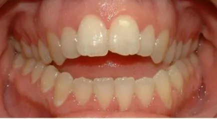 Distrugerea smaltul dintilor cauze, simptome, factori externi, boli