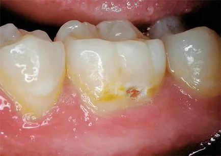Distrugerea smaltul dintilor cauze, simptome, factori externi, boli