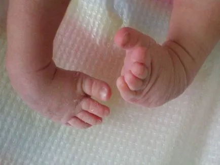 Rahitismul la sugari Simptome si fotografii de tratament (simptome) Rahitismul la sugari simptome și tratament foto