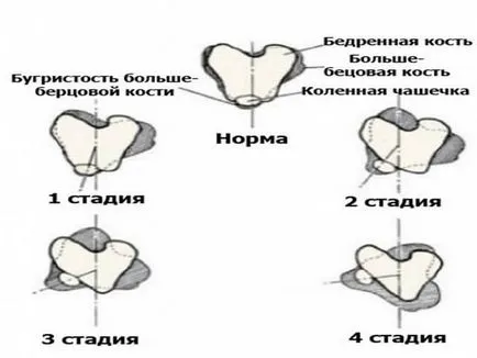 Fractura simptomelor genunchiului si tratamentul video (ligamente) Întinzându ligamentelor genunchiului simptomelor comune și a fișierelor video de tratament