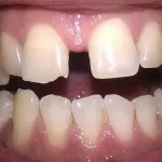 Opritor după acolade pe care le dau și cât de mult ar trebui să fie purtate (aparat dentar) Opritor după acolade pe care le dau și cât de mult trebuie să purtați