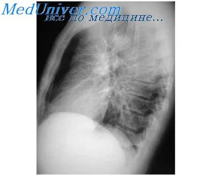 Proprietățile reologice ale sângelui, boli pulmonare vâscozității sângelui