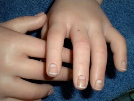 Birthmark pe deget - inel, indicele, mijloc, mână mare, dreapta și stânga, valoarea