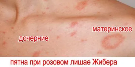 zosterian roz Gibert cauze, simptome, tratament (motiv) Pink zosterian Gibert cauze, simptome, tratament