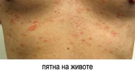 zosterian roz Gibert cauze, simptome, tratament (roz) Pink zosterian Gibert cauze, simptome, tratament