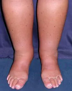 Simptome cardiace edeme și tratament (edem) Simptome edeme cardiace și tratament