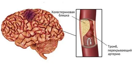 Heart Attack - cauze, cum sa recunoasca simptomele si pentru a oferi primul ajutor