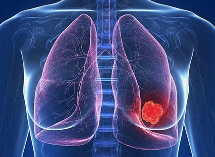 Sarcom a sânului care este, simptomele si tratamentul cancerului de sân la femei