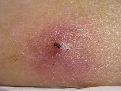 Bump pe piept la femei și bărbați (cucui) Bump pe piept la femei și bărbați