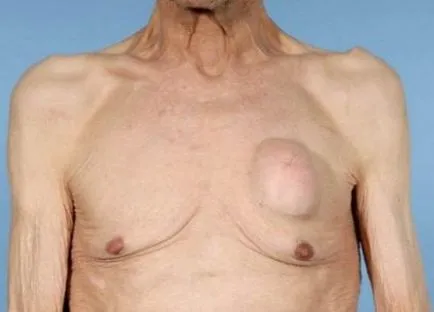 Bump (cucui, excrescență) pe piept sau coaste cauzele (piept cucui cucui excrescență coaste osoase ieșită) Bump (bump, excrescență), pe piept sau coaste cauzele
