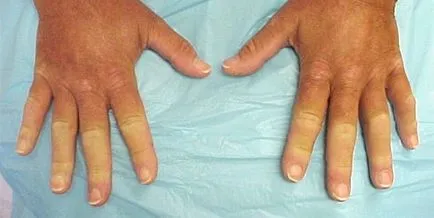 sindromul Raynaud - ce este simptome, cauze si tratament