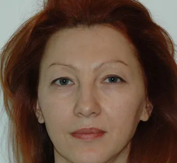 Cum de a reduce ridurile de sub ochi si in jurul ochilor, reintinerirea pielii (în jurul) Cum de a reduce ridurile de sub ochi si in jurul ochilor, reintinerirea pielii