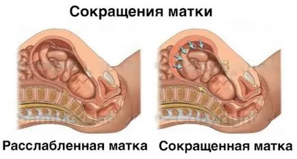 tonusul uterului în timpul sarcinii simptome, cauze si tratament (tonusul uterului în timpul sarcinii simptome 2 trimestru) tonusul uterului în timpul sarcinii simptome, cauze si tratament
