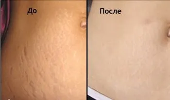 Eliminarea vergeturi toate metodele moderne și diferențele lor