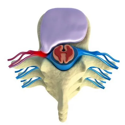 Eliminarea costurilor herniat a operațiunii, consecințele comentarii