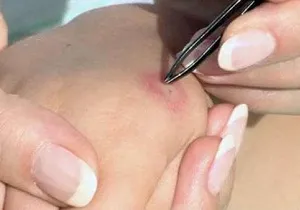 Intepaturi de albina ce să facă acasă și cum să acorde primul ajutor